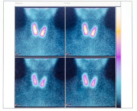 radioiodoterapia carcinoma papilífero